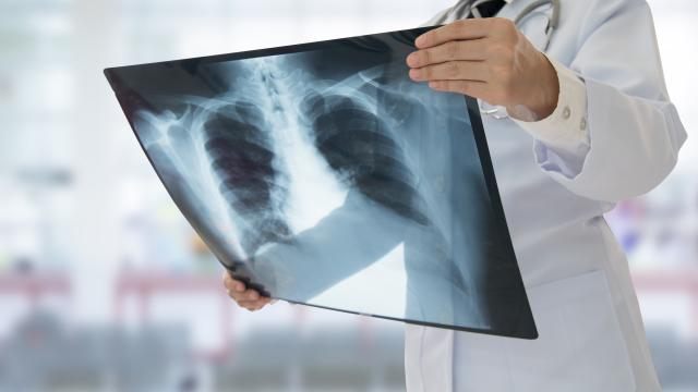 Doctor examining a chest x-ray