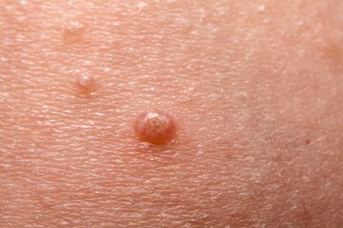 Small red bumps on skin or water warts, close view.
