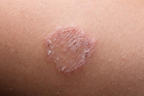 Crusting circle spot on skin or ring worm infection.