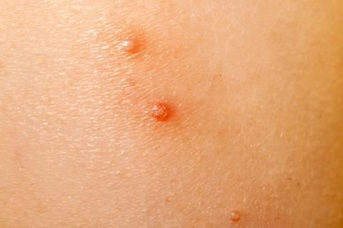 Water warts as red bumps on skin.
