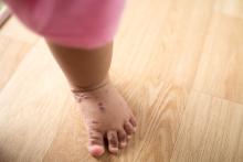 Hand, foot, and mouth on a toddler's foot